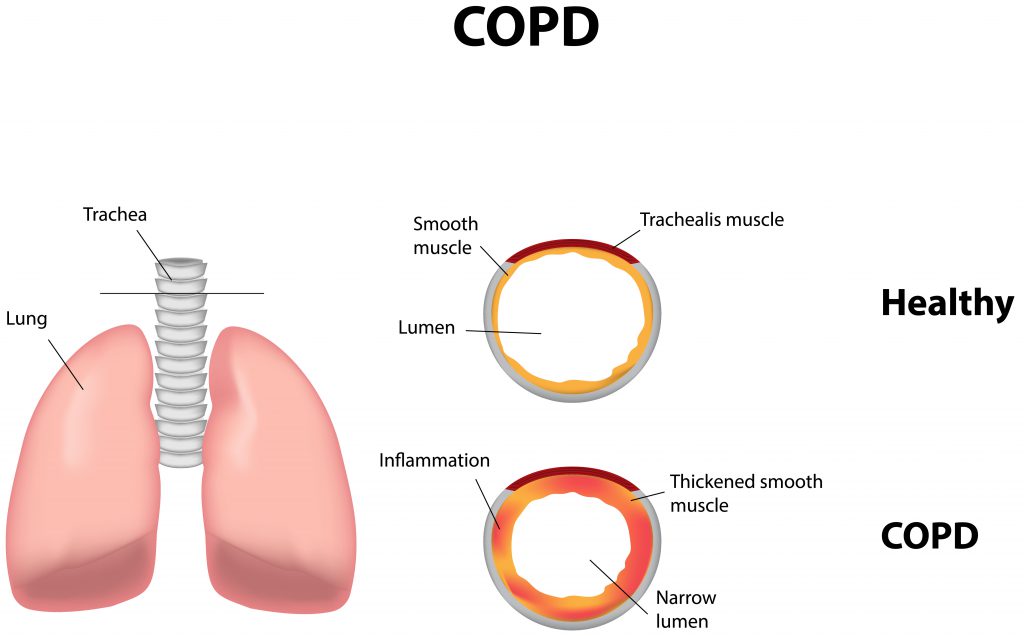 copd_keuhkoahtaumatauti